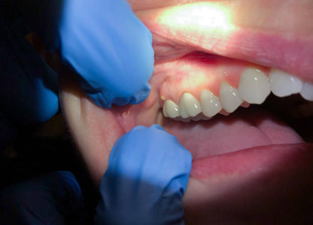 Best Broken Tooth Emergency  in Tenino, WA